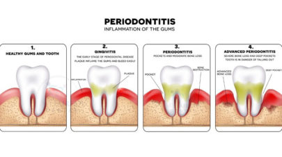 Gum or Periodontal Disease