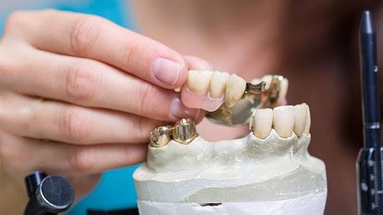 Modern Dental Metal Alloys