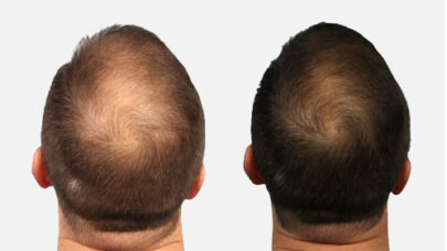 Signs Baldness And How Control