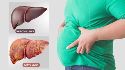 Role Ayurveda in The Treatment Of Fatty Liver | Cause & Problems