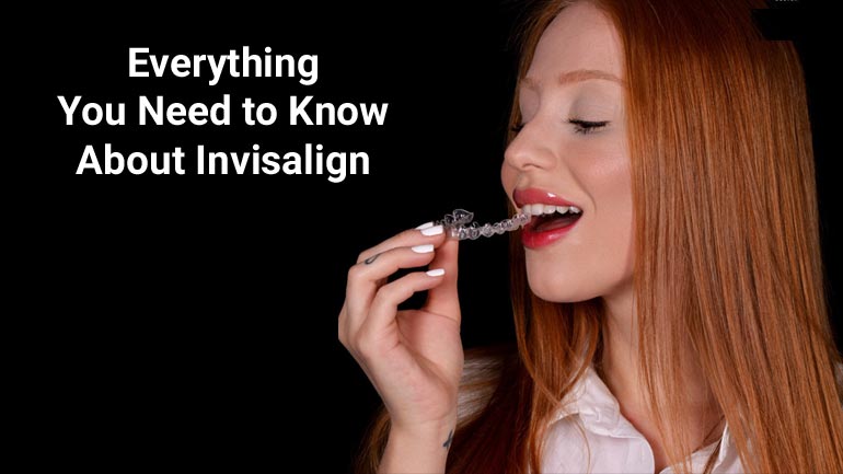 Invisalign Things Need Know