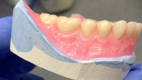 Partial Denture Implants