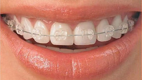 Clear-Braces-More-Expensive