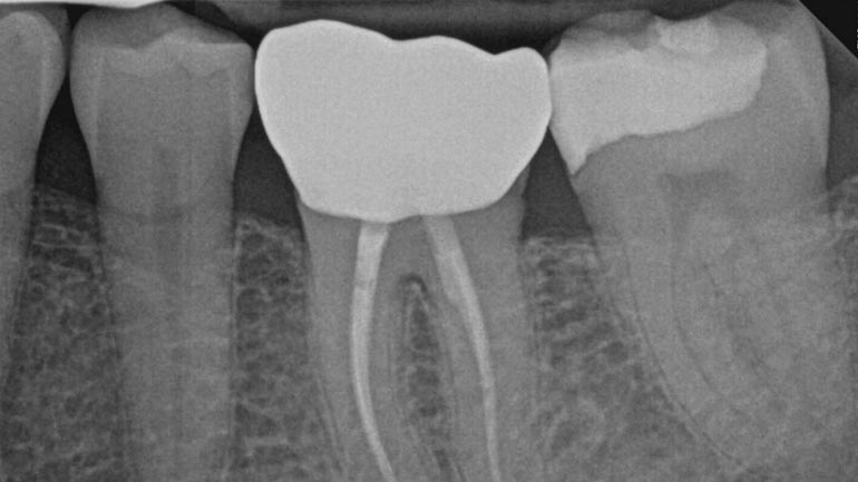 Root-Canal-Therapy