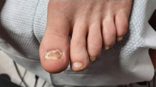 Feet Fungus Infection
