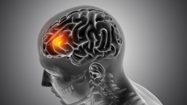 What is The Only Known Risk Factor for Brain Tumors?