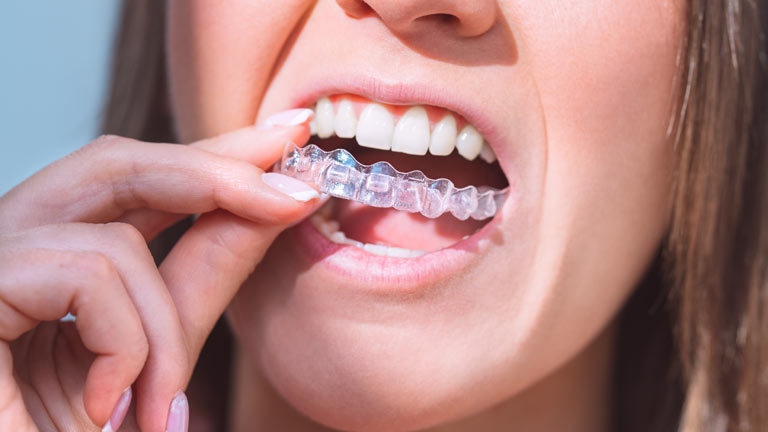 What are the Benefits of Invisalign and Why do People Prefer It?