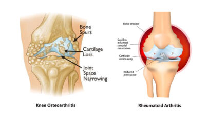 Knee Osteoarthritis And Rheumatoid Arthritis
