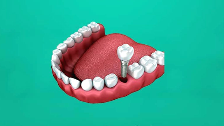 Know About Dental Implants