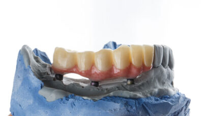 Choose Dentist for Implants