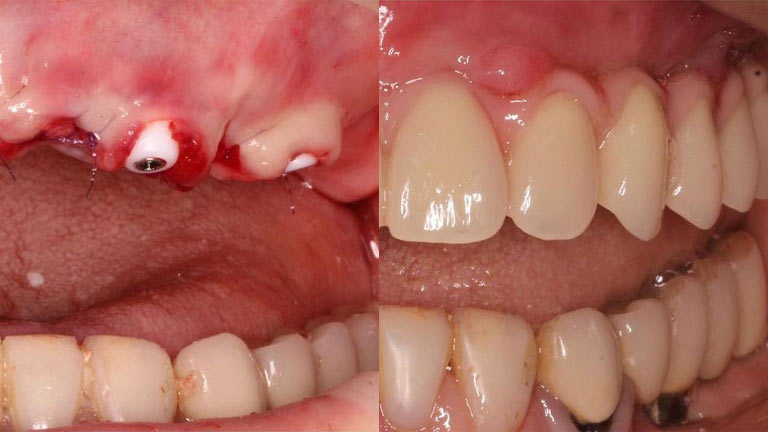 Swelling Last After Dental Implant