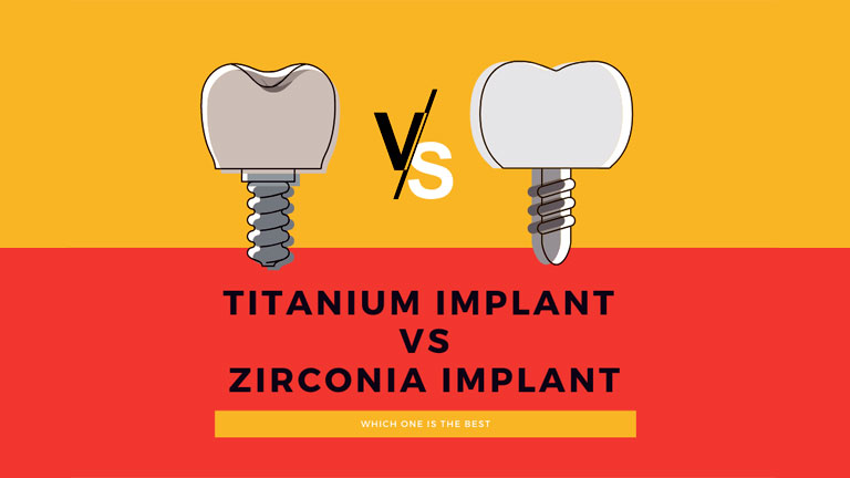 Titanium vs Zirconia Implant