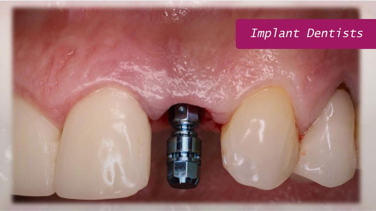 Dental Implant Dentists