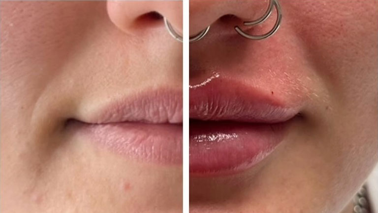 Guide to Lip Fillers
