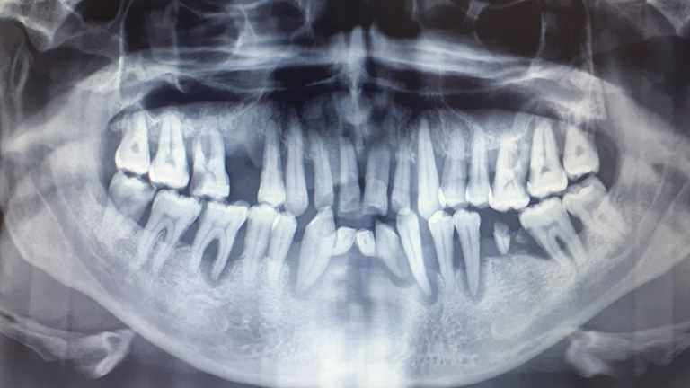 aggressive periodontitis gum disease opg