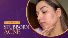 Dealing with Stubborn Acne