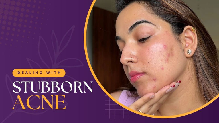 Dealing with Stubborn Acne