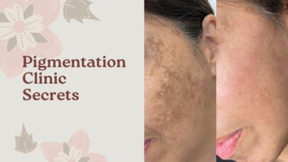 Pigmentation Clinic Secrets