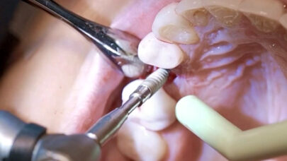 Implant Dentists Treatment Plans