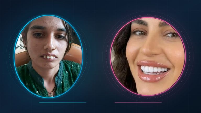 Gaps Misalignment and straight Teeth