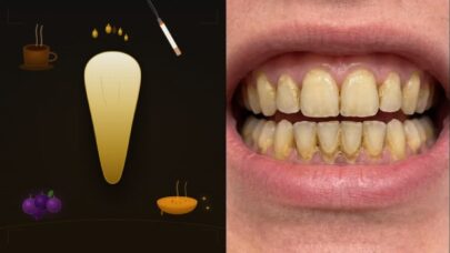 Causes of Yellow Teeth