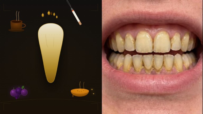 Causes of Yellow Teeth