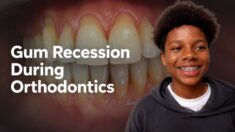 Gum Recession during Orthodontic