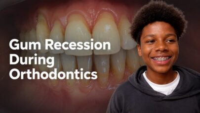 Gum Recession during Orthodontic