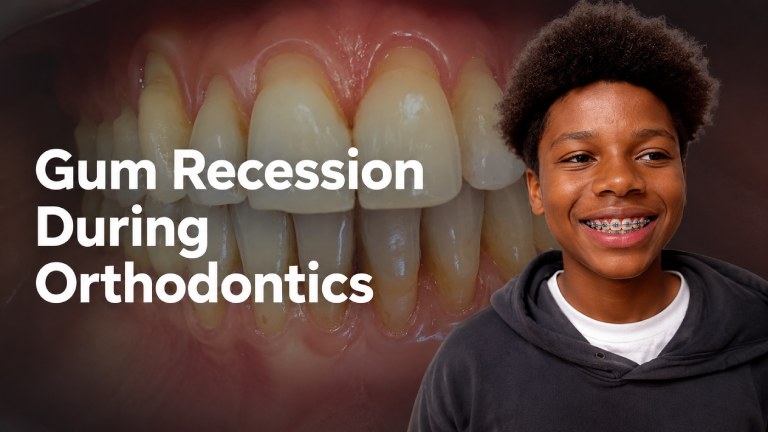 Gum Recession during Orthodontic