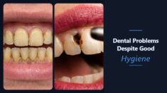 Tooth Problems Despite Oral Hygiene