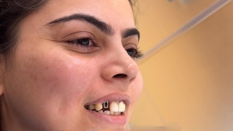Benefits Of Choosing Dental Implants