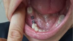 Complete Dental Implant Process