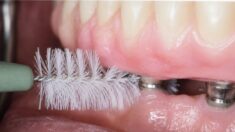 Clean Between Implant Crowns and Gums