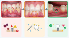 Periodontal Treatment Improves Implant Success