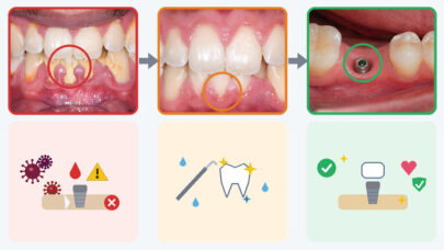 Periodontal Treatment Improves Implant Success